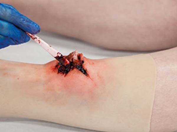 Trauma FX - Simsleeve - Ankle - Open Fracture